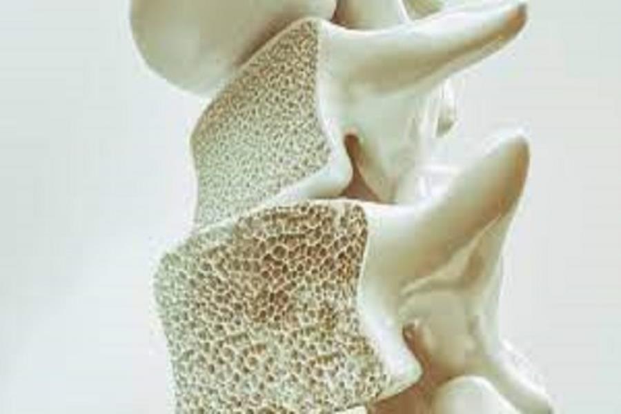 استفاده از فناوری نانو برای درمان پوکی استخوان